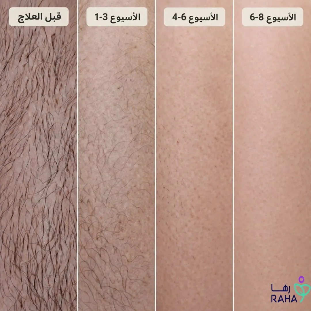 نتائج ليزر الجسم الكامل قبل وبعد